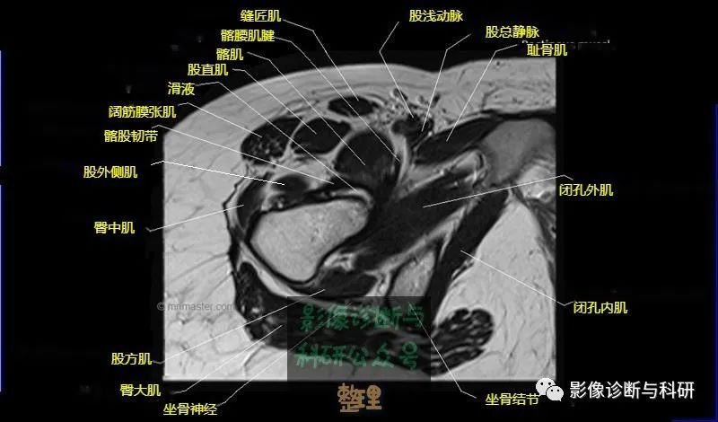 髋关节MR轴位详细标注-16 髋关节MR轴位详细标注-16