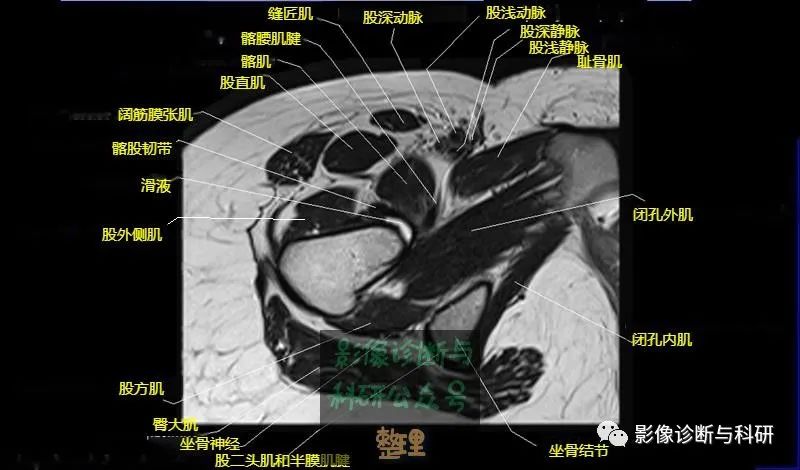 髋关节MR轴位详细标注-17 髋关节MR轴位详细标注-17