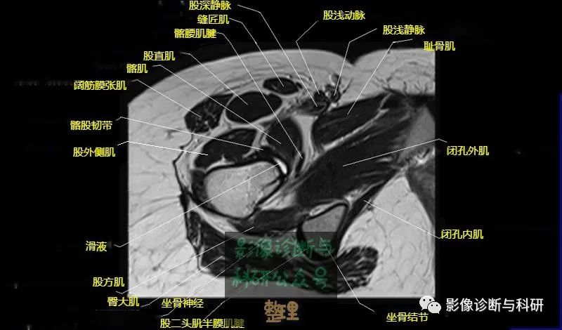 髋关节MR轴位详细标注-18 髋关节MR轴位详细标注-18