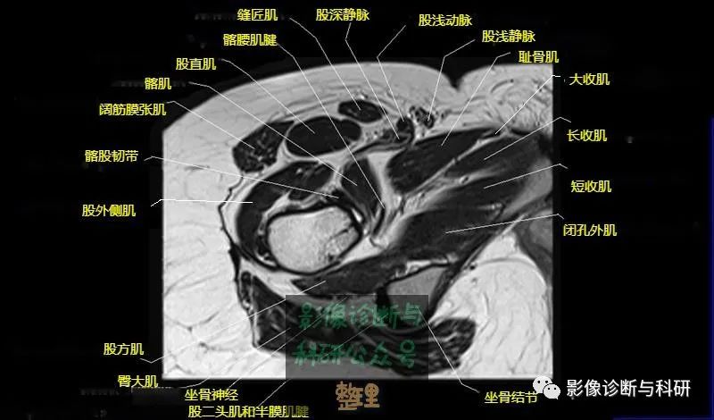 髋关节MR轴位详细标注-19 髋关节MR轴位详细标注-19