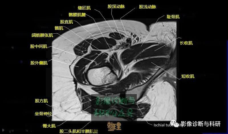髋关节MR轴位详细标注-20 髋关节MR轴位详细标注-20