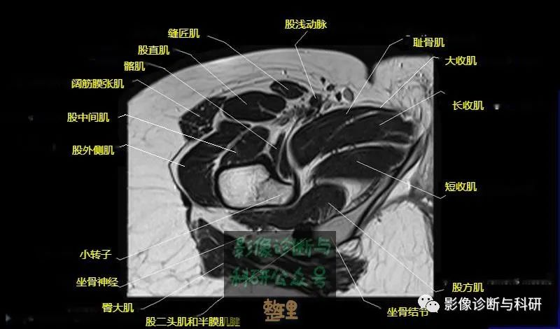 髋关节MR轴位详细标注-21 髋关节MR轴位详细标注-21