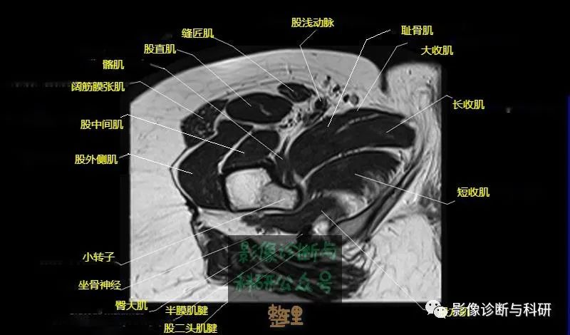 髋关节MR轴位详细标注-22 髋关节MR轴位详细标注-22