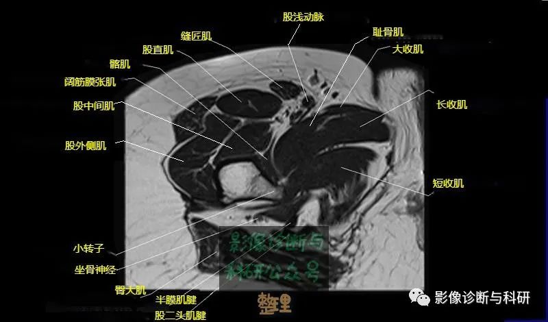 髋关节MR轴位详细标注-23 髋关节MR轴位详细标注-23