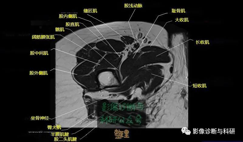 髋关节MR轴位详细标注-24 髋关节MR轴位详细标注-24