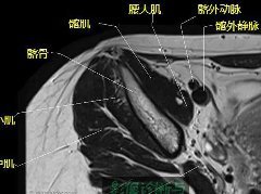 髋关节MR轴位详细标注