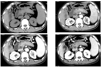 自身免疫性胰腺炎的影像学表现-2