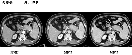 自身免疫性胰腺炎的影像学表现-5