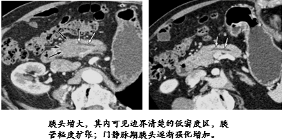 自身免疫性胰腺炎的影像学表现-4