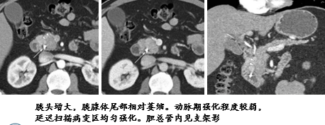 自身免疫性胰腺炎的影像学表现-3