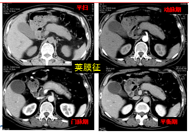 自身免疫性胰腺炎的影像学表现-1