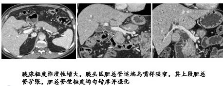 自身免疫性胰腺炎的影像学表现-6