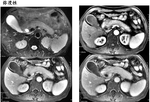 自身免疫性胰腺炎的影像学表现-7