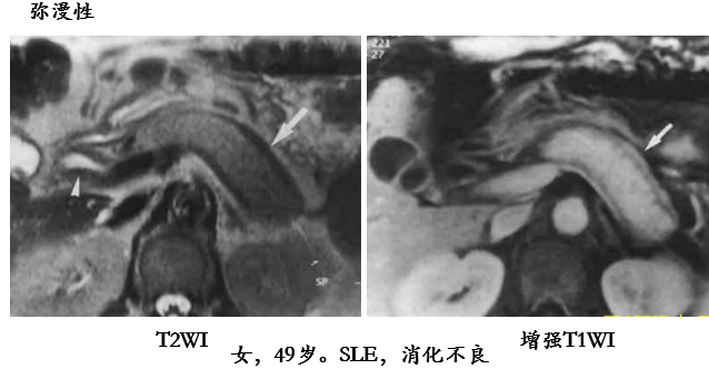 自身免疫性胰腺炎的影像学表现-8