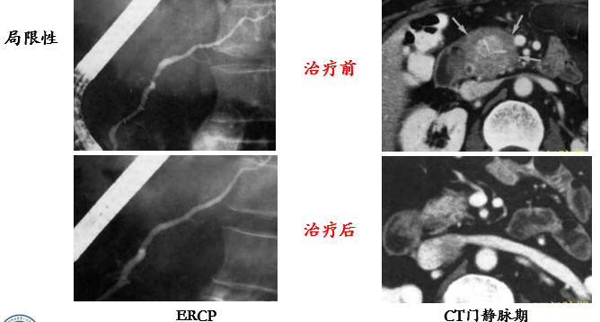 自身免疫性胰腺炎的影像学表现-9