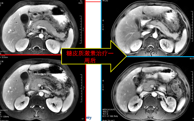 自身免疫性胰腺炎的影像学表现-10