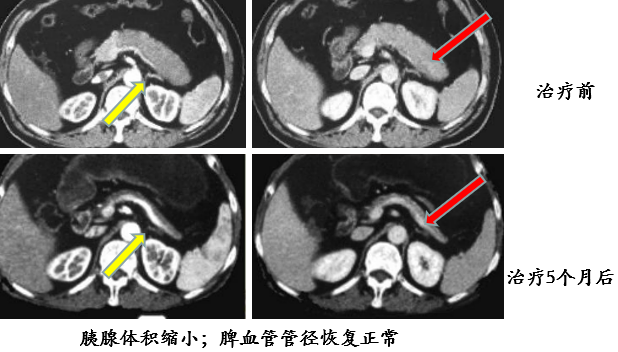 自身免疫性胰腺炎的影像学表现-11