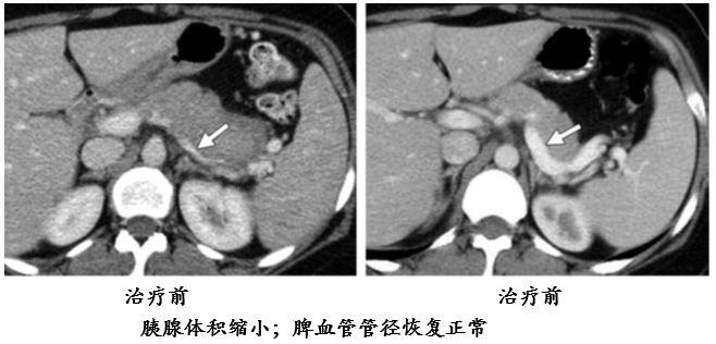 自身免疫性胰腺炎的影像学表现-12