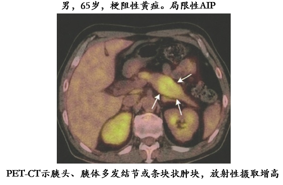 自身免疫性胰腺炎的影像学表现-14