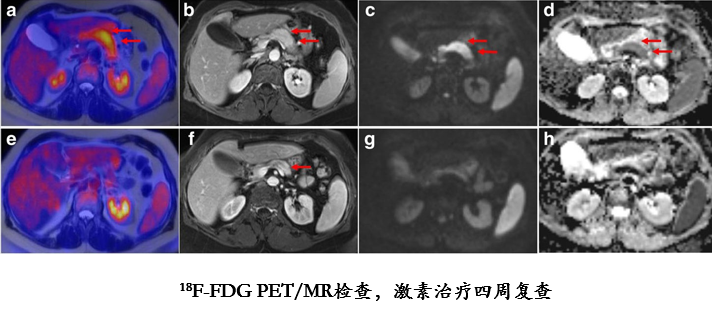自身免疫性胰腺炎的影像学表现-15