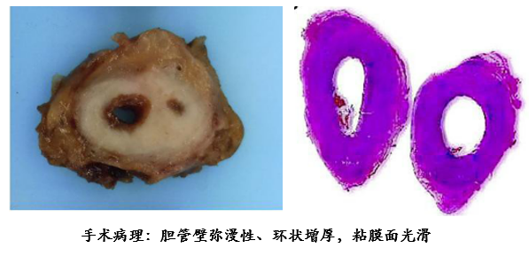 自身免疫性胰腺炎的影像学表现-16