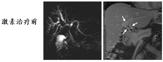 自身免疫性胰腺炎的影像学表现-18