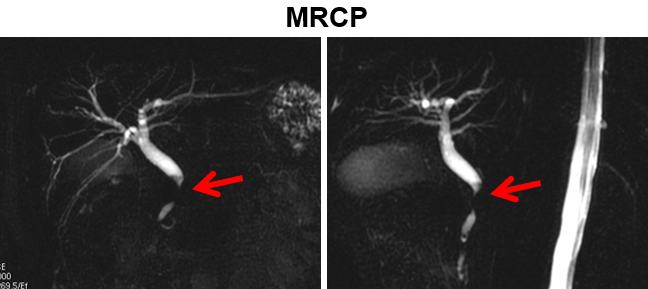 自身免疫性胰腺炎的影像学表现-17