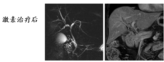 自身免疫性胰腺炎的影像学表现-19