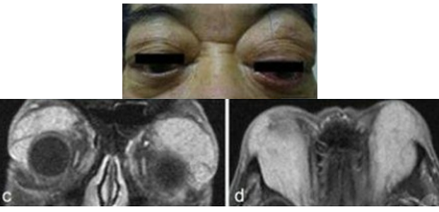 自身免疫性胰腺炎的影像学表现-20