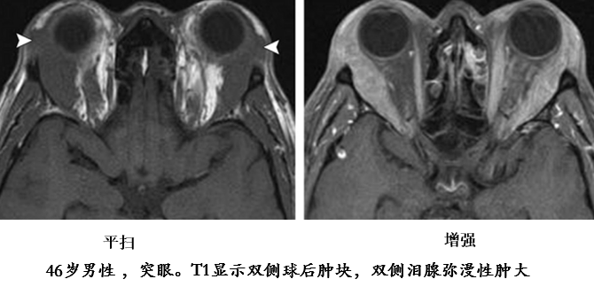 自身免疫性胰腺炎的影像学表现-21
