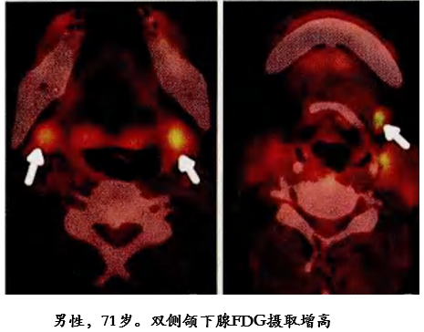 自身免疫性胰腺炎的影像学表现-23