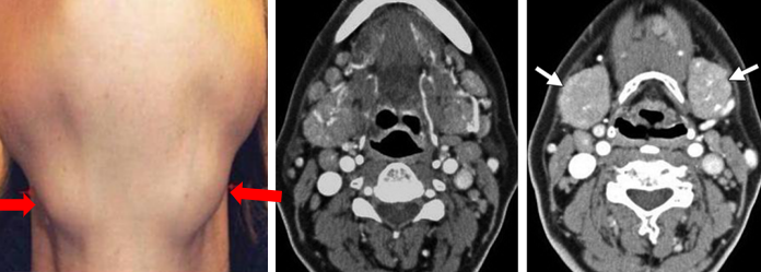 自身免疫性胰腺炎的影像学表现-22