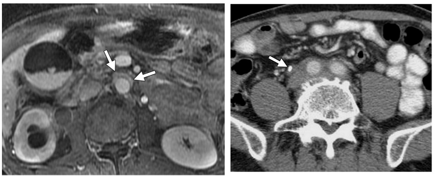 自身免疫性胰腺炎的影像学表现-24