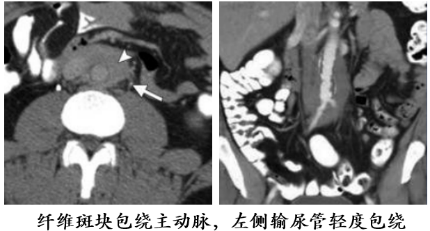 自身免疫性胰腺炎的影像学表现-25