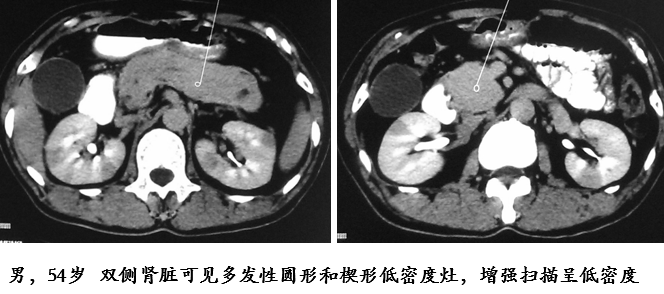 自身免疫性胰腺炎的影像学表现-27