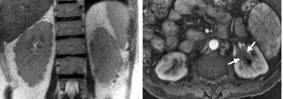 自身免疫性胰腺炎的影像学表现-28