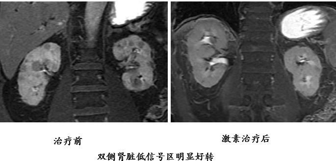 自身免疫性胰腺炎的影像学表现-29