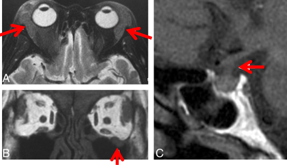 自身免疫性胰腺炎的影像学表现-30