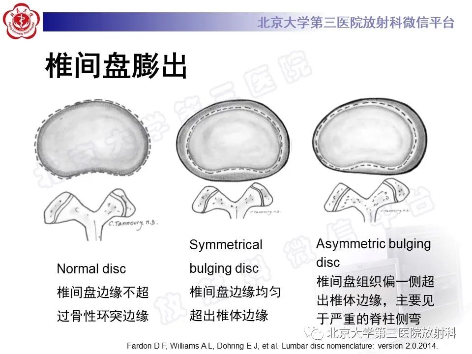 【PPT】椎间盘膨出与疝出-5