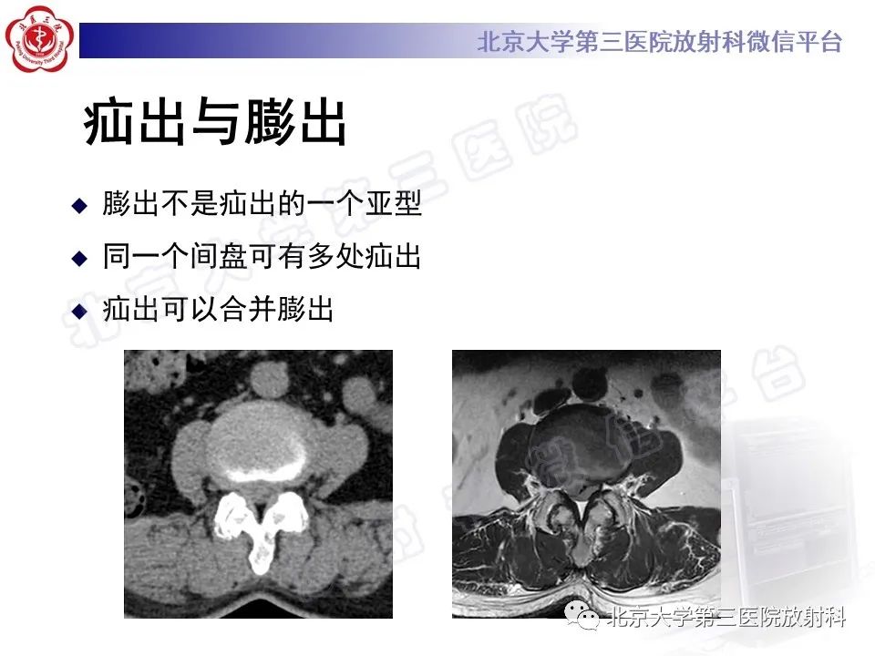 【PPT】椎间盘膨出与疝出-9