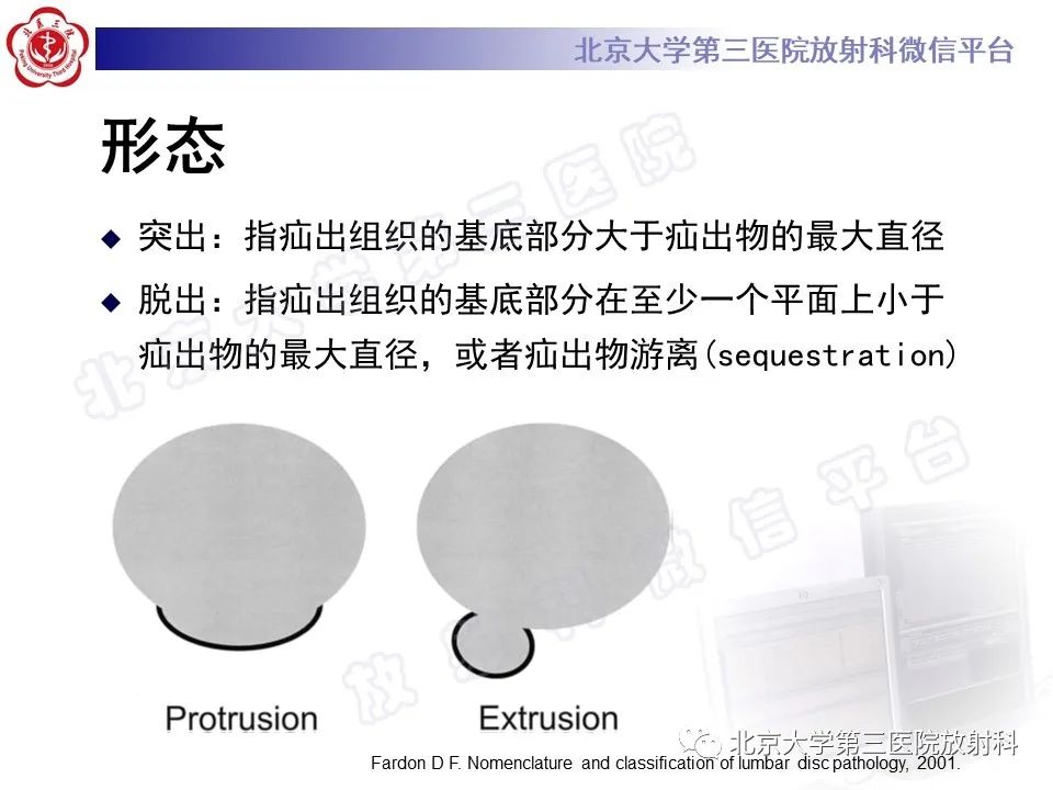 【PPT】椎间盘膨出与疝出-11