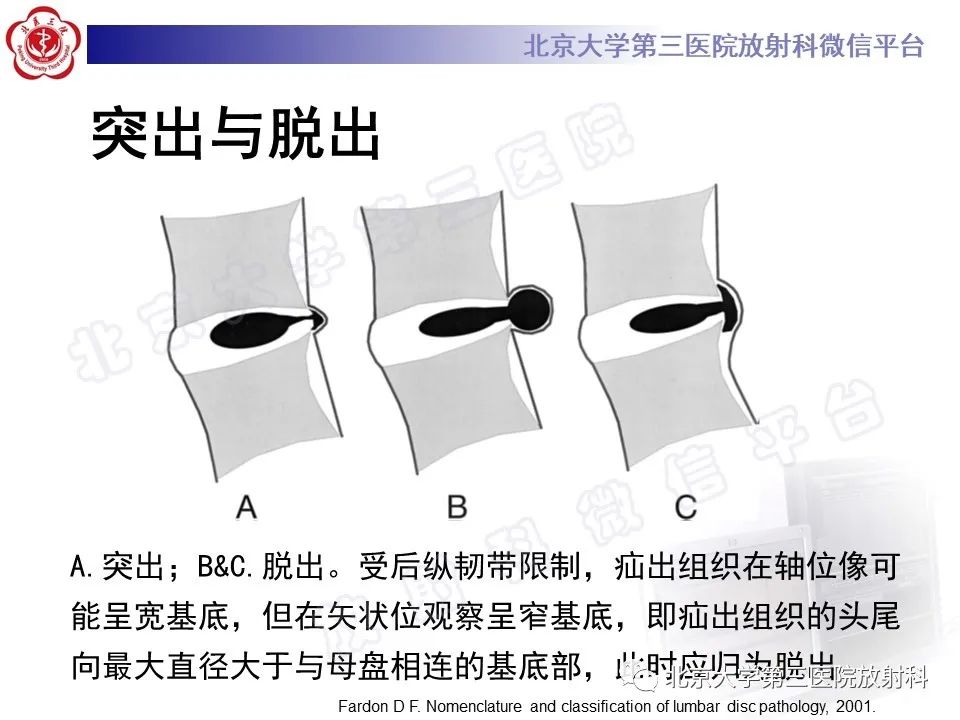 【PPT】椎间盘膨出与疝出-12
