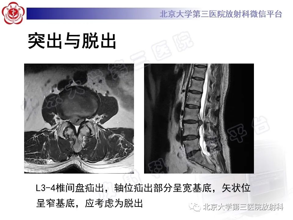 【PPT】椎间盘膨出与疝出-13