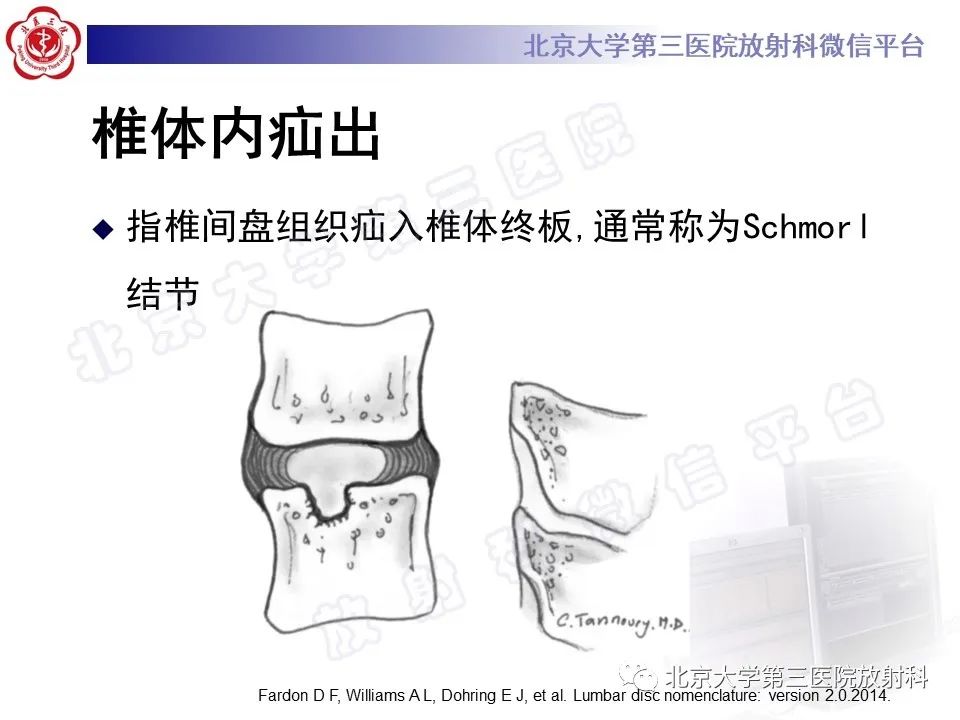 【PPT】椎间盘膨出与疝出-14
