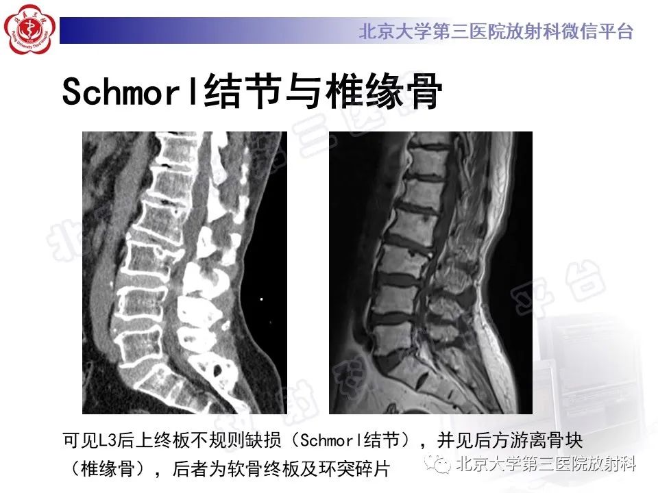 【PPT】椎间盘膨出与疝出-16