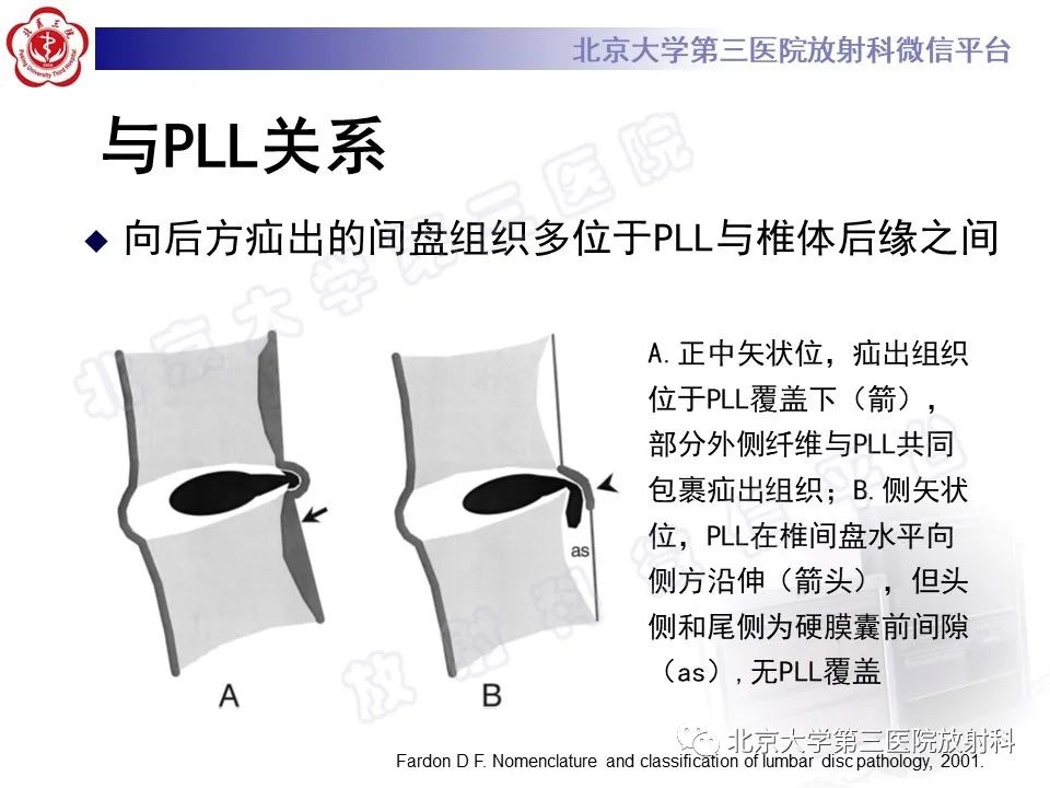 【PPT】椎间盘膨出与疝出-18
