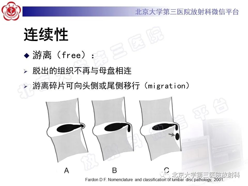 【PPT】椎间盘膨出与疝出-20