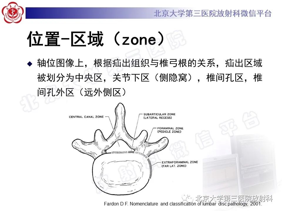 【PPT】椎间盘膨出与疝出-23