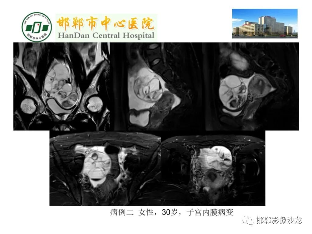 【PPT】卵巢非肿瘤性病变的影像诊断-3