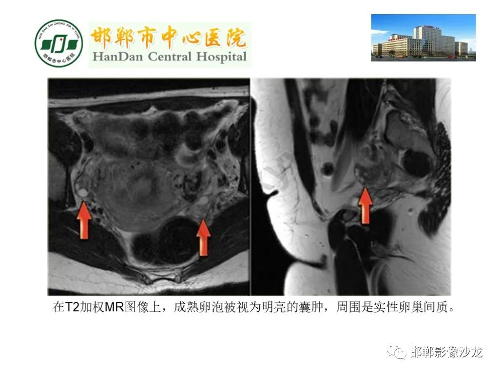 【PPT】卵巢非肿瘤性病变的影像诊断-8